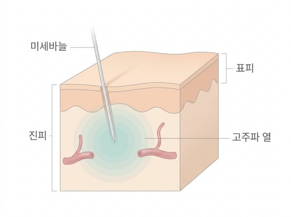 포텐자는 미세바늘로 고주파 열을 피부 속에 넣는 시술이라 붉은 기가 따라오며, 문헌상 대개 수 시간~수일(목적에 따라 24시간~7일) 안에 가 - 광주포텐자 | 미미썸의원 광주광천점