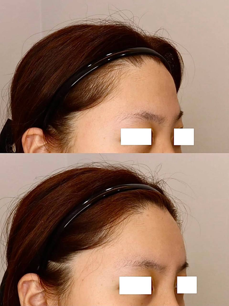이마,코필러 리얼 후기