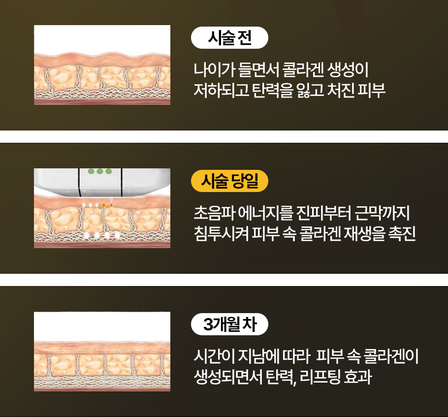 시술 전 - 나이가 들면서 콜라겐 생성이 저하되고 탄력을 잃고 처진 피부   시술 당일 - 초음파 에너지를 진피부터 근막까지 침투시켜 피부 속 콜라겐 재생을 촉진   3개월 차 - 시간이 지남에 따라 피부 속 콜라겐이 생성되면서 탄력, 리프팅 효과